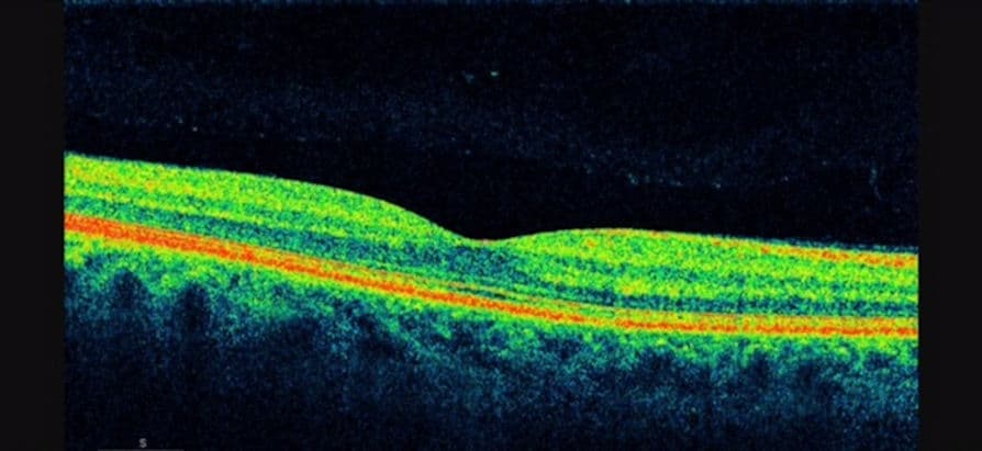 image of the macula with ocular coherence tomography