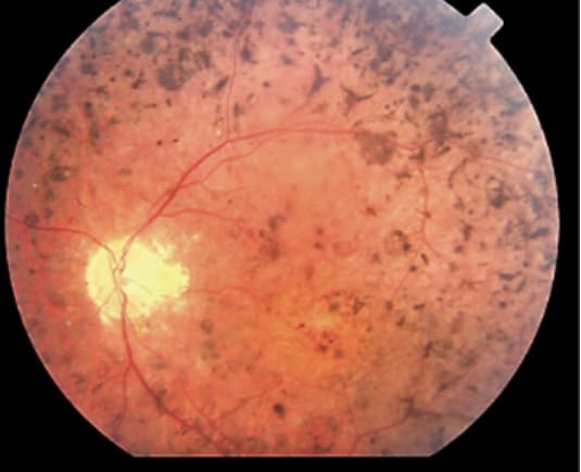 retinal image of retinitis pigmentosa
