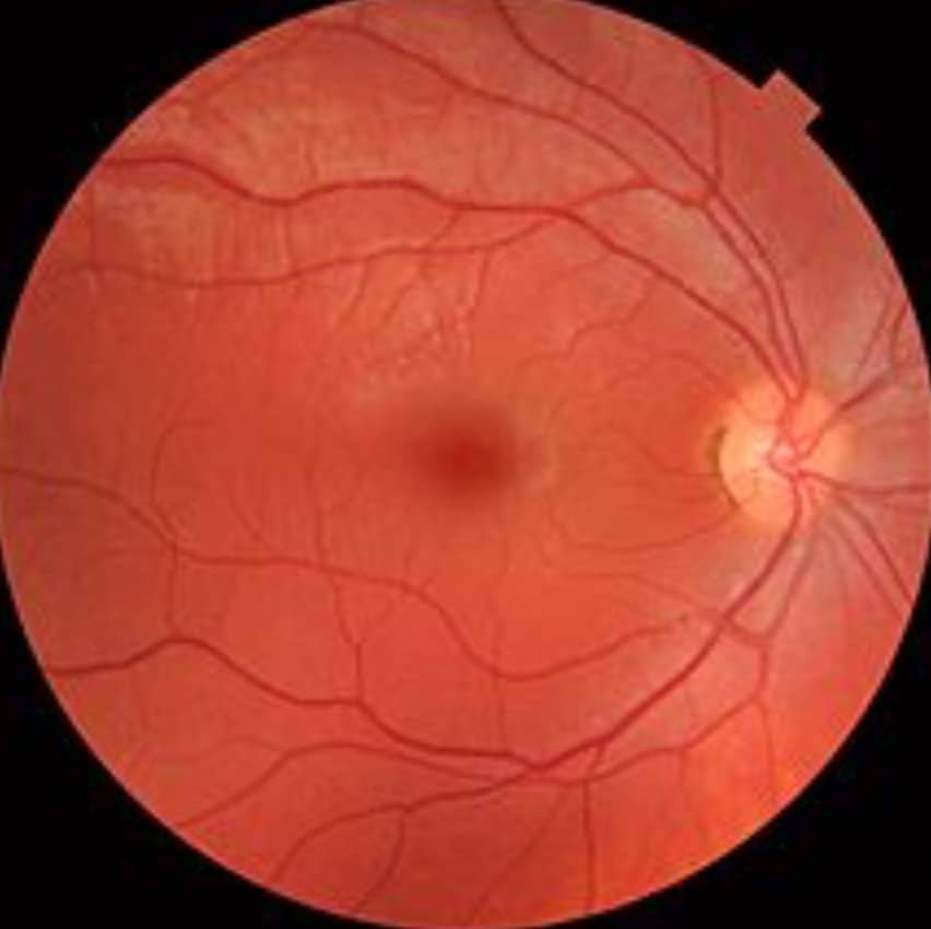 photo of the retina of a healthy eye
