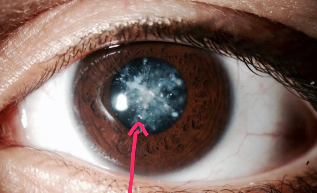 eye shown a lens cataract