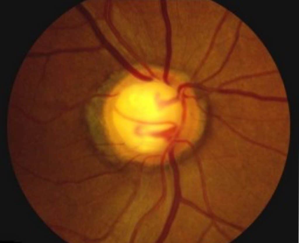 fundus photo of an optic nerve with glaucoma