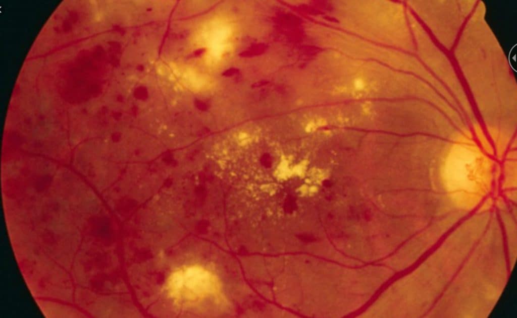 fundus photo of retinal damage due to diabetes