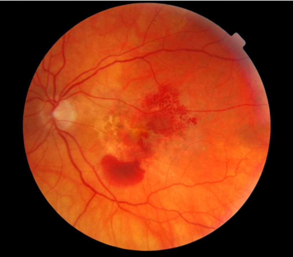 photo of wet macular degeneration