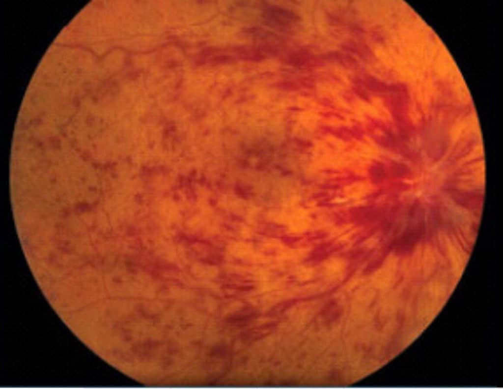 fundus photo showing many areas of hemorrhages and fluid leakage of a central retinal vein occulsion