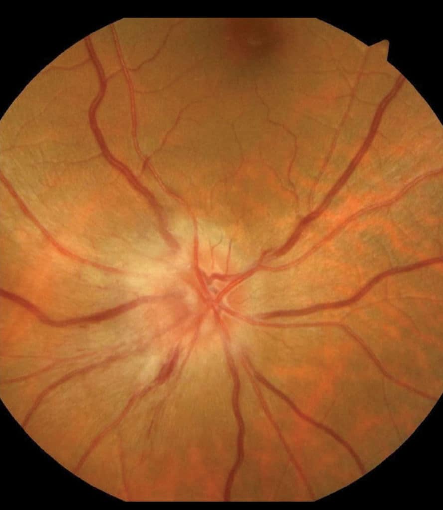 fundus photo of an optic nerveenlarged from non arteritic anterior optic neuropathy