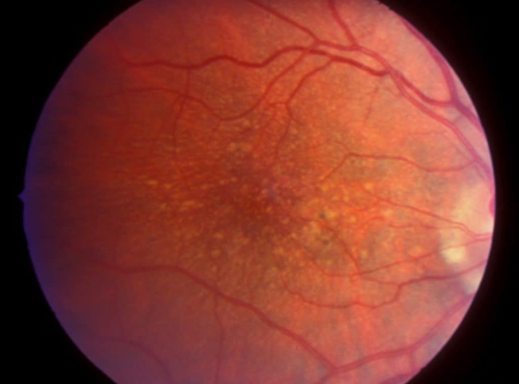 fundus photo of drusen in the macula